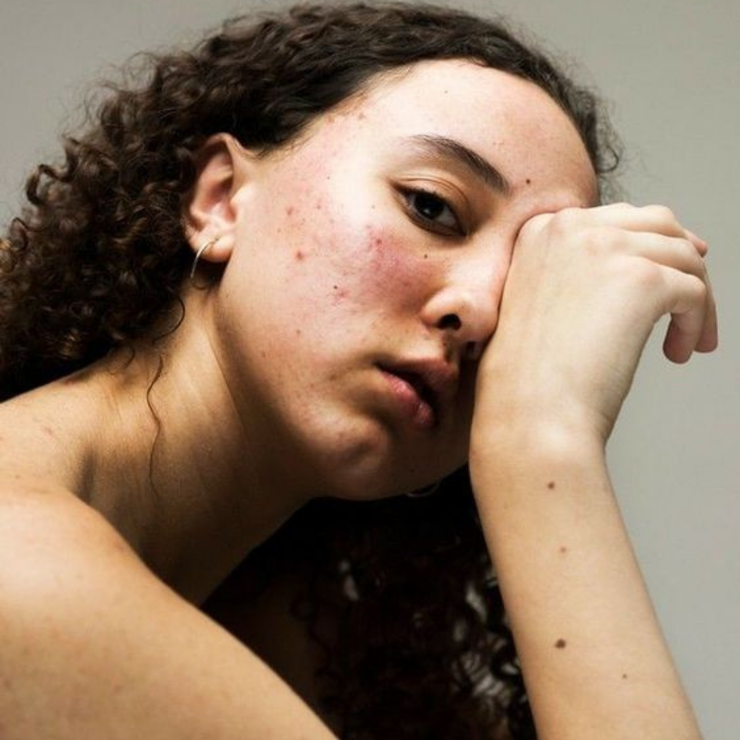 Los efectos del estrés en la piel: cómo las emociones impactan directamente su salud