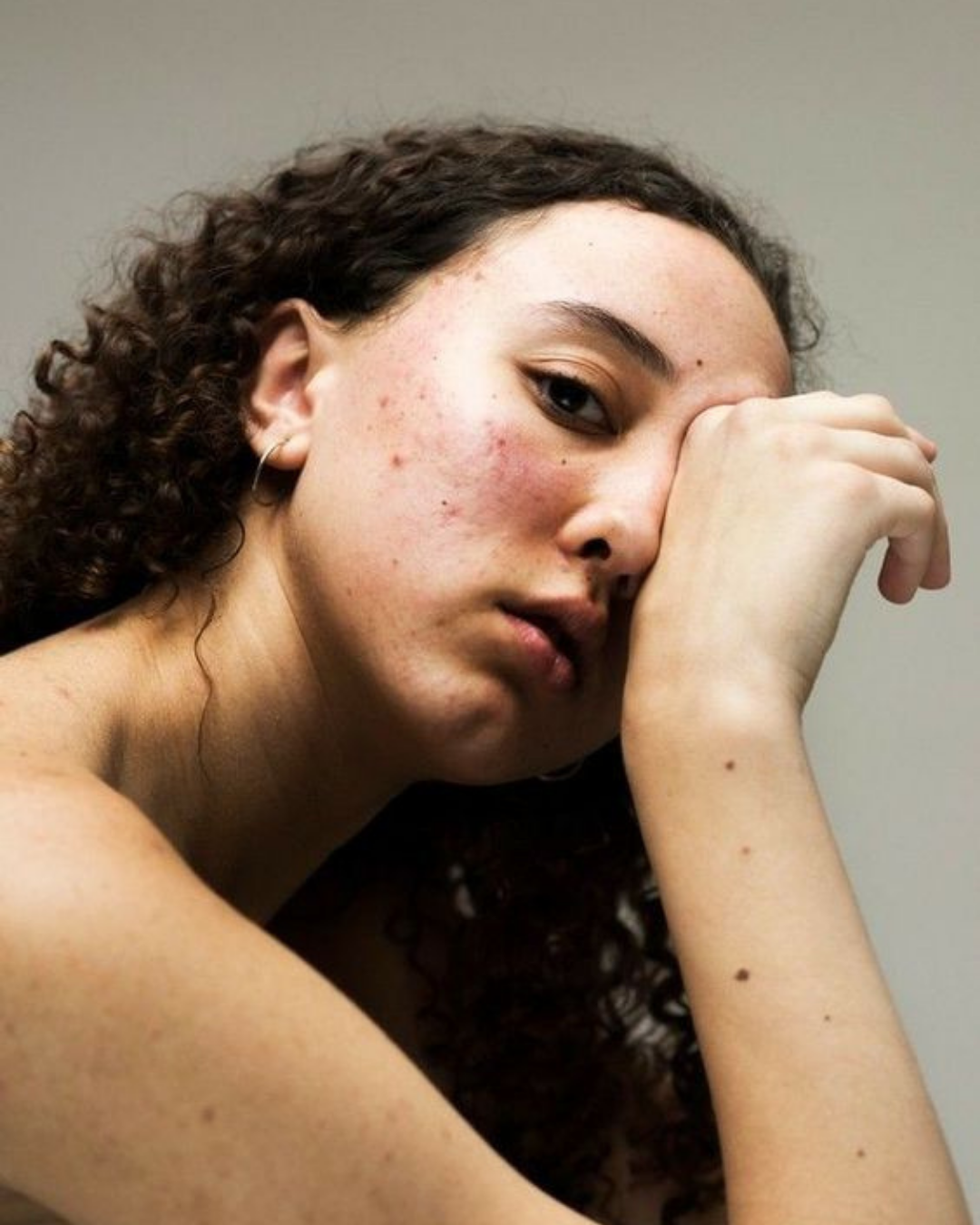 Los efectos del estrés en la piel: cómo las emociones impactan directamente su salud