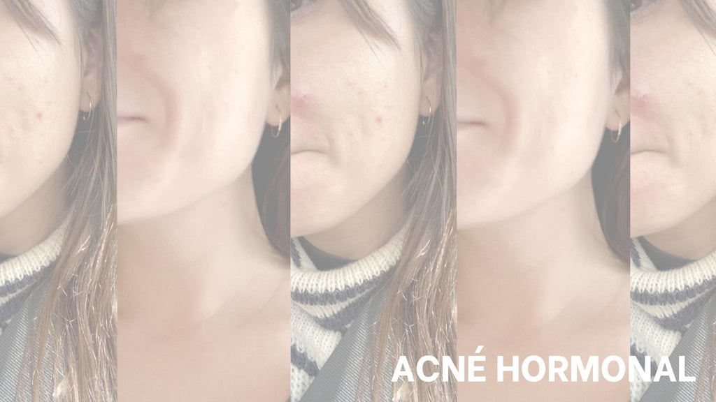 SOS, j’ai de l’acné hormonale : que faire ?